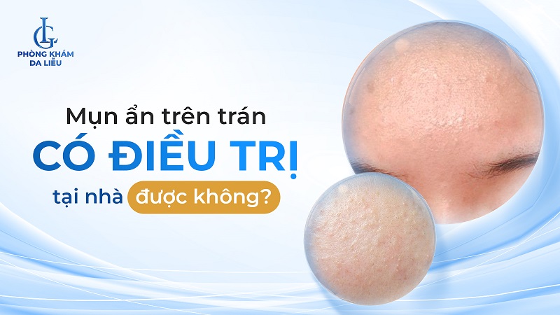 mụn ẩn trên trán