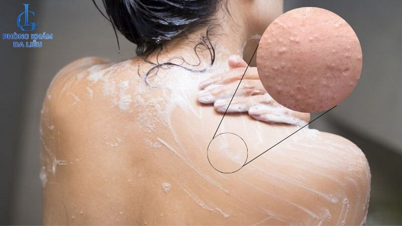 nguyên nhân gây mụn ẩn ở lưng