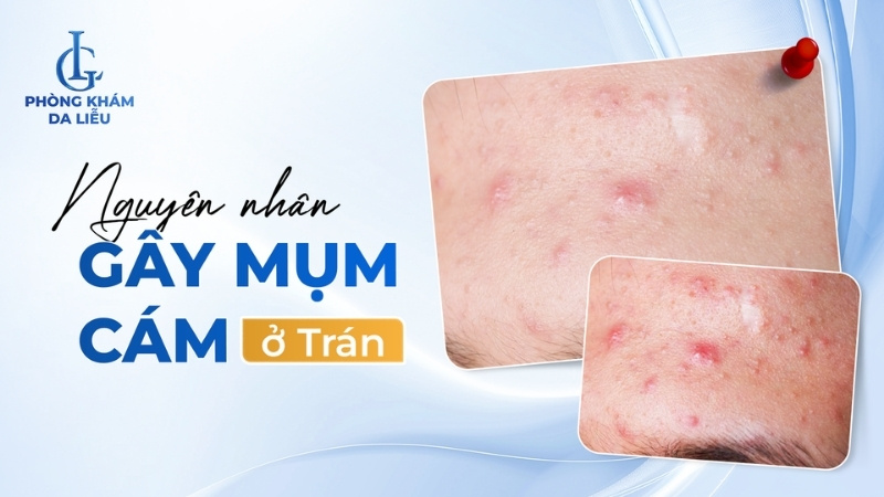 nguyên nhân gây mụn cám ở trán