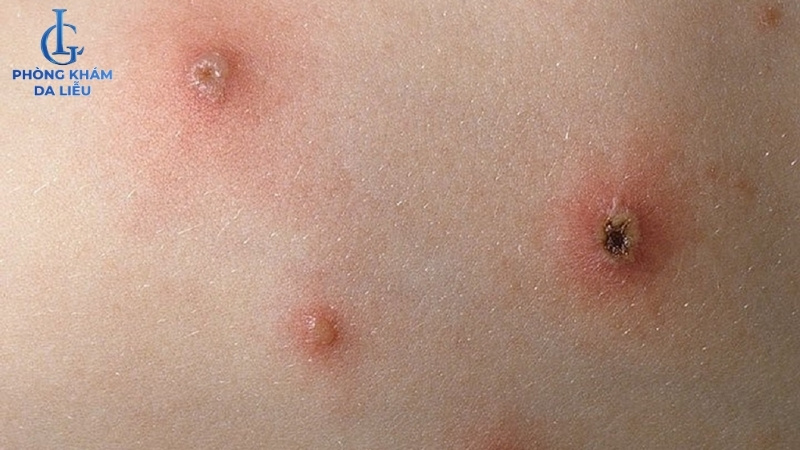 nguyên nhân gây ra sẹo rỗ