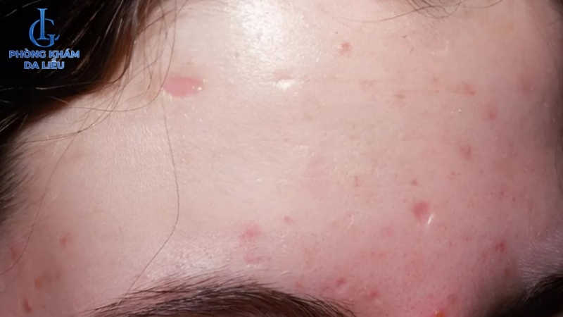 nguyên nhân sẹo rỗ