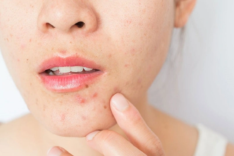 Vitamin e tốt cho da mụn