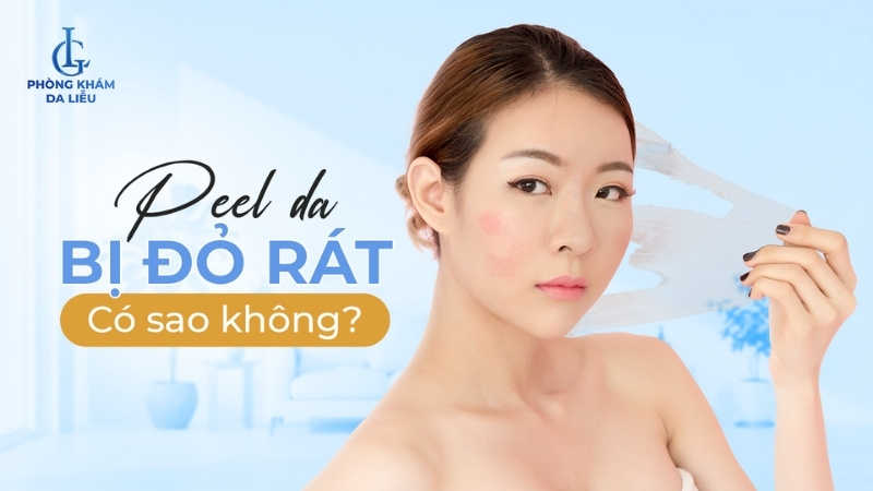 peel da bị đỏ rát