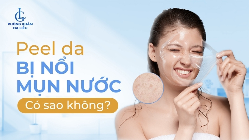 peel da bị nổi mụn nước có sao không