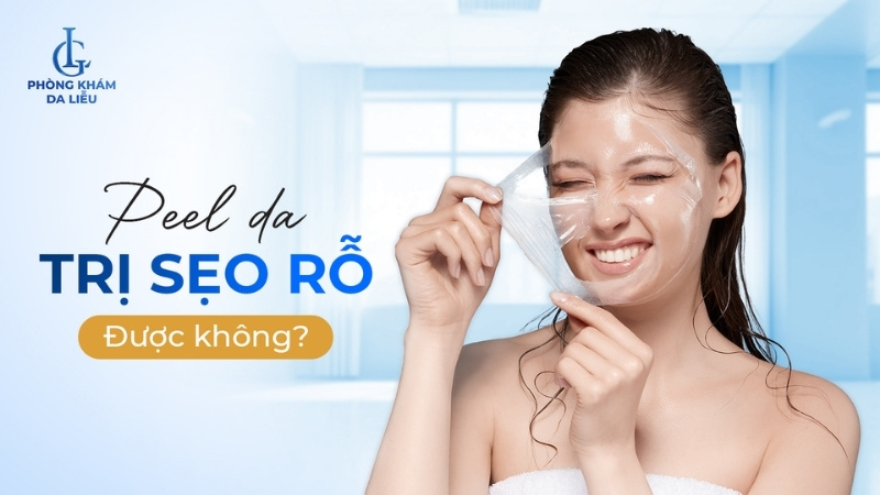 peel da để điều trị sẹo rỗ