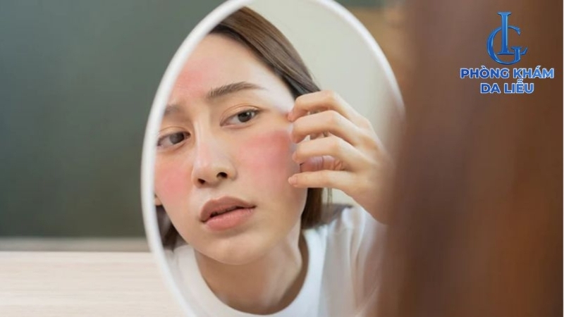 peel da điều trị sẹo rỗ