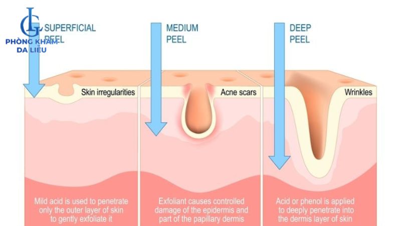 Peel da trị mụn có làm mỏng da không