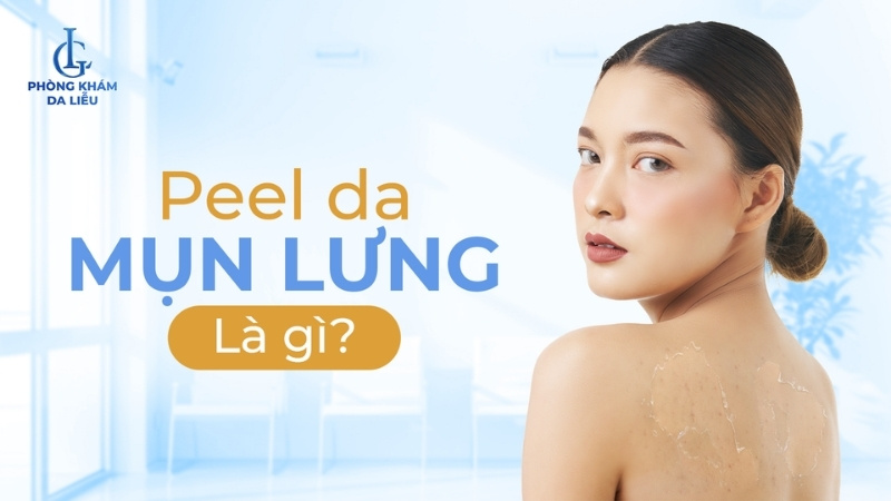 peel da trị mụn lưng