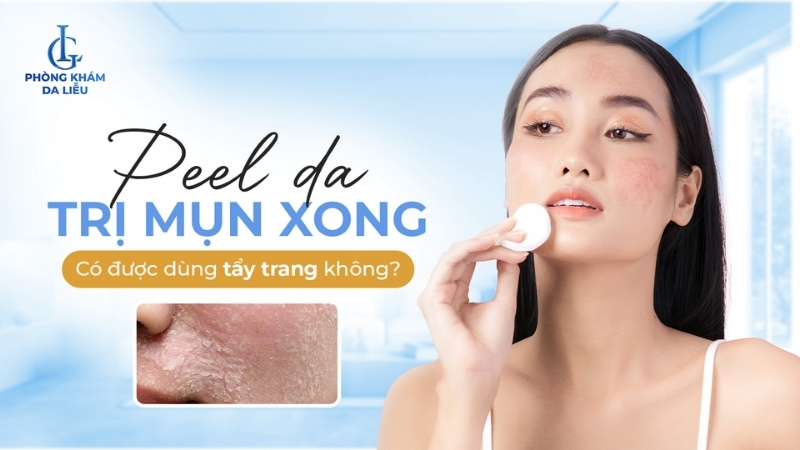 peel da trị mụn