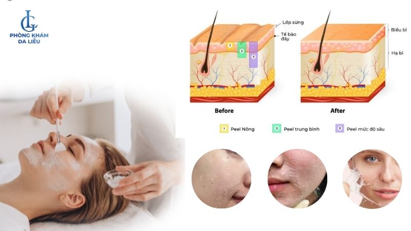 peel da trị sẹo rỗ