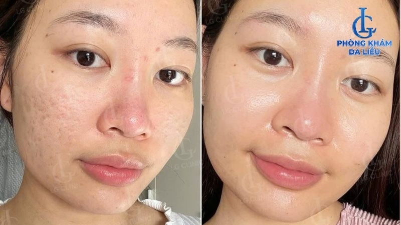 peel da trị sẹo rỗ