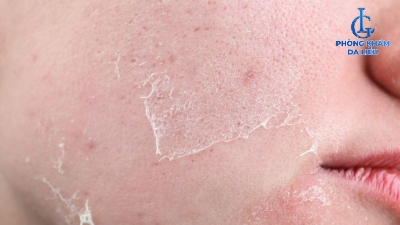 peel da trị sẹo rỗ gây bong tróc