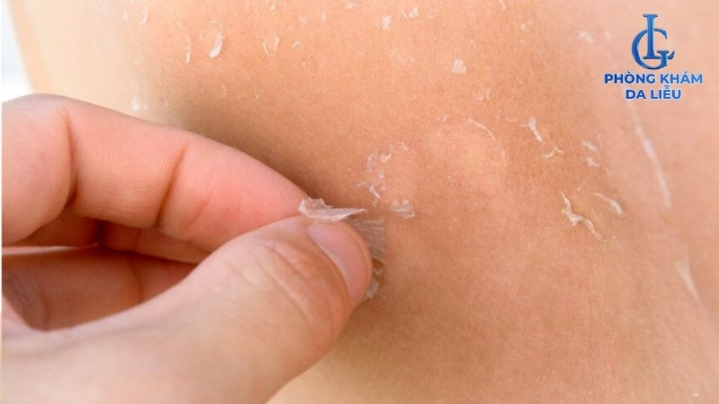 peel da trị sẹo rỗ gây tróc da