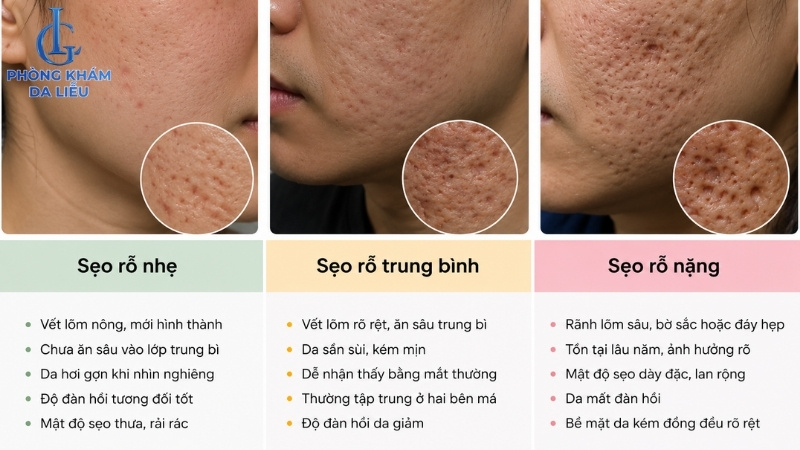 phân loại sẹo rỗ theo mức độ sẹo