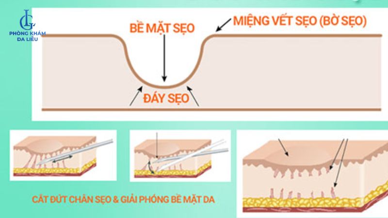 phương pháp cắt đáy sẹo