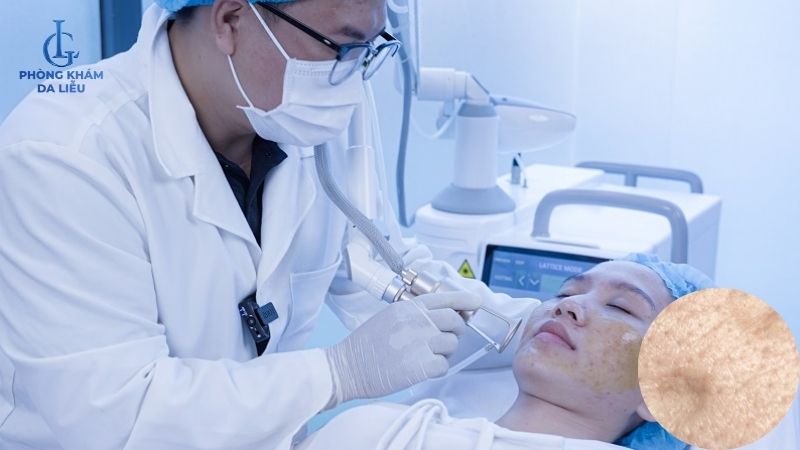 quy trình điều trị sẹo rỗ