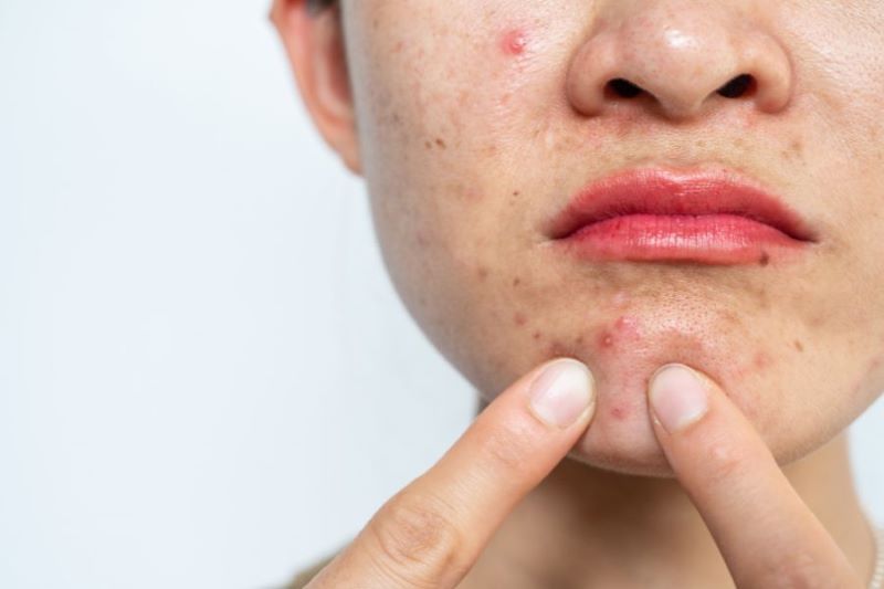 Tại sao rối loạn nội tiết tố nam gây mụn