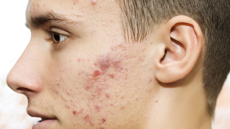 Tại sao rối loạn nội tiết tố nam gây mụn?