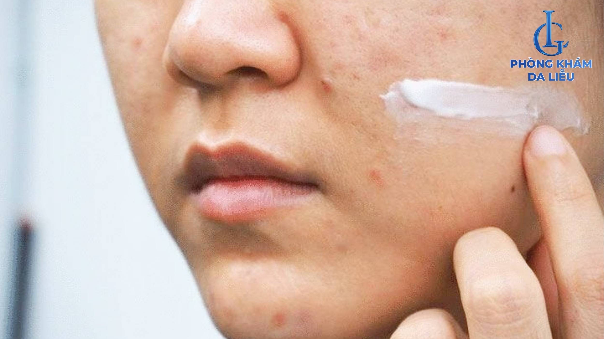 Bôi kem trị sẹo