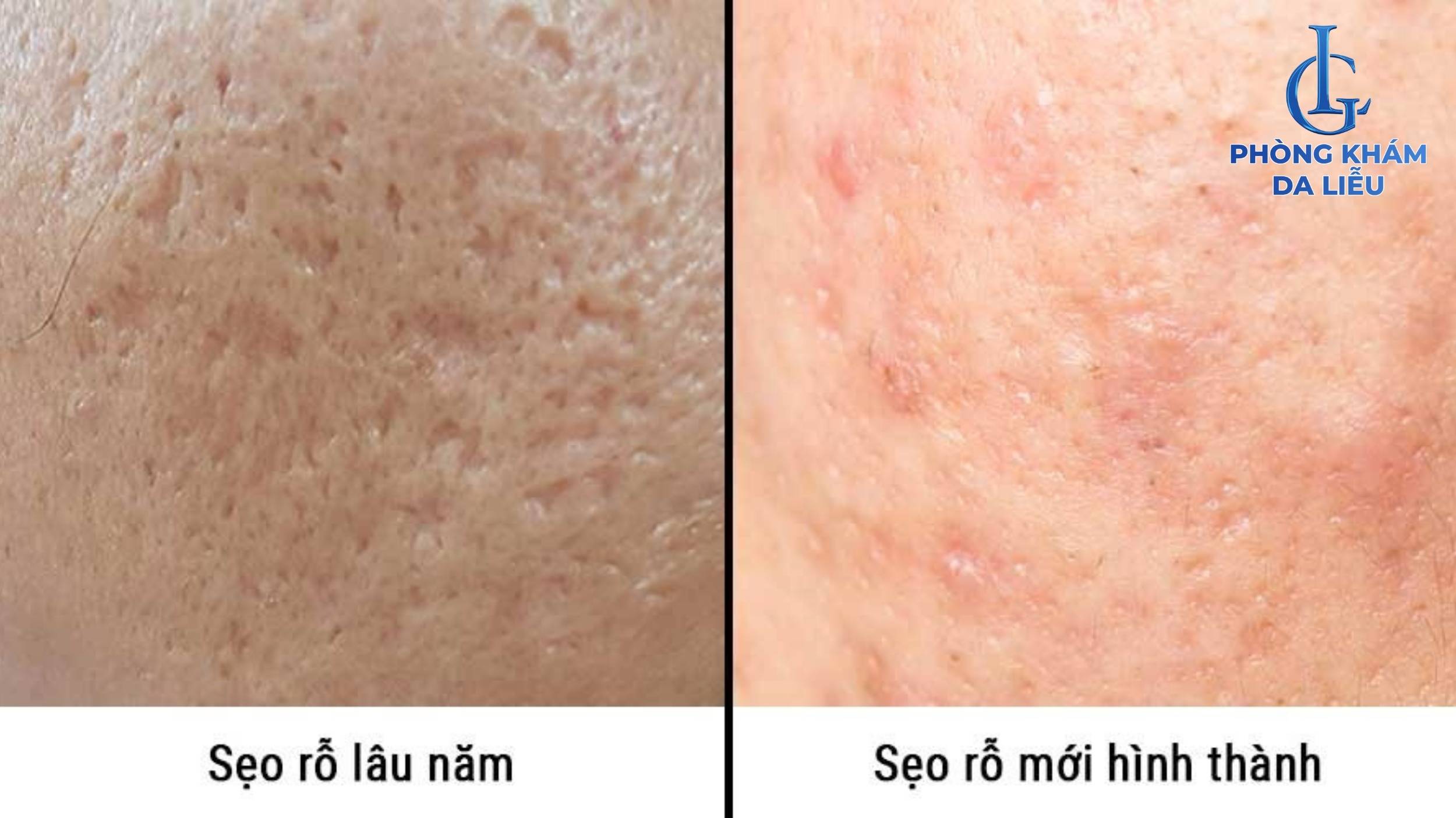 Sẹo rỗ mới và lâu năm