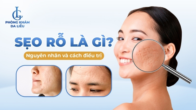 sẹo rỗ là gì