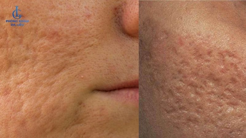 sẹo rỗ nặng