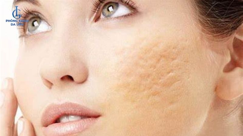 sẹo rỗ trung bình