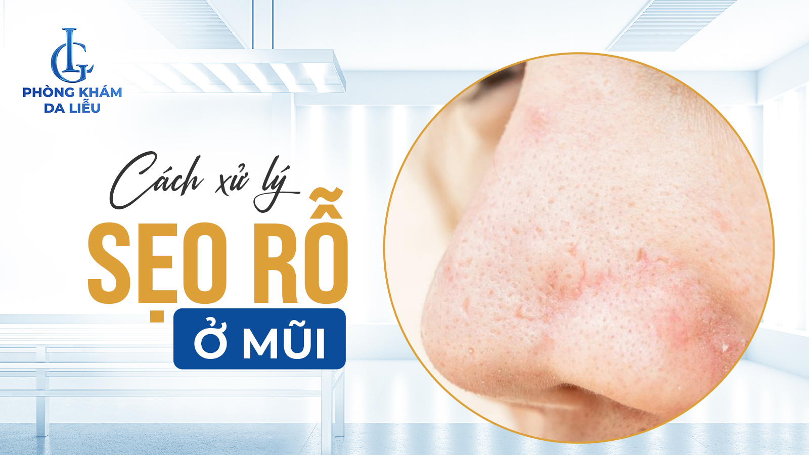 Sẹo rỗ ở mũi