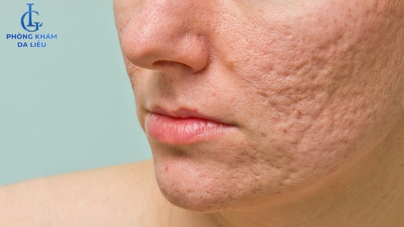 thời gian điều trị sẹo rỗ theo mức độ tổn thương