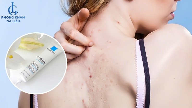 thuốc bôi trị mụn ẩn ở lưng