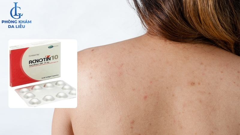 thuốc uống trị mụn ẩn ở lưng