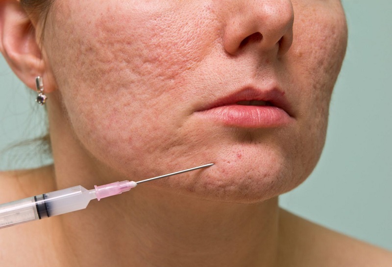 Tiêm collagen làm đầy sẹo lõm là gì?