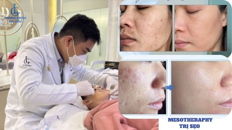 tiêm meso trị sẹo rỗ