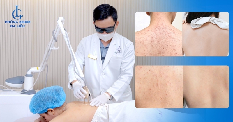 trị mụn ẩn ở lưng tại phòng khám da liễu