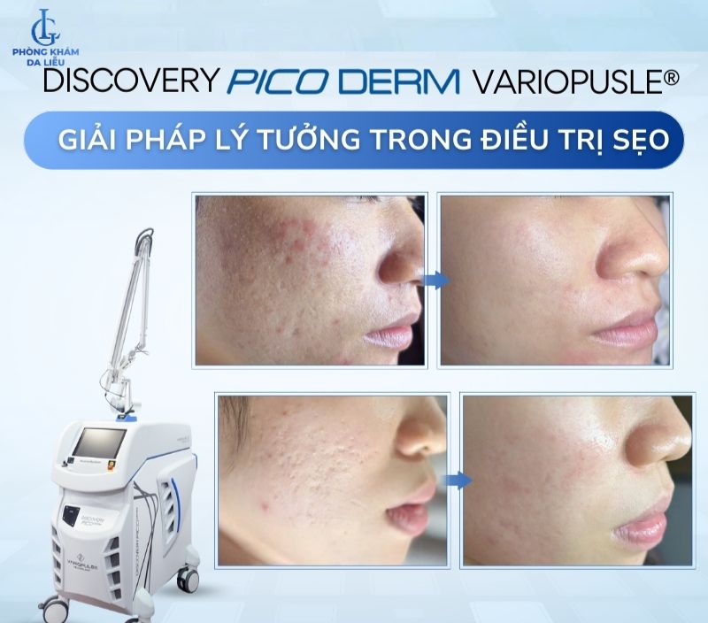 Discovery trị sẹo rỗ