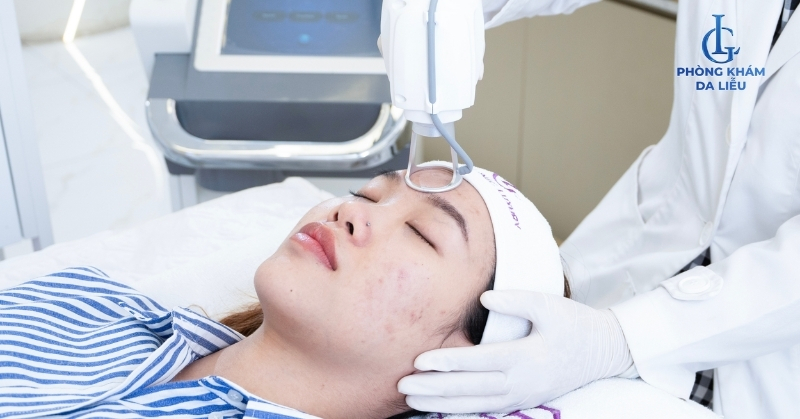 trị sẹo rỗ bằng laser CO2