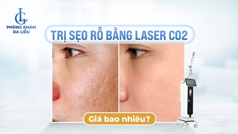 trị sẹo rỗ bằng laser co2 bao nhiêu tiền