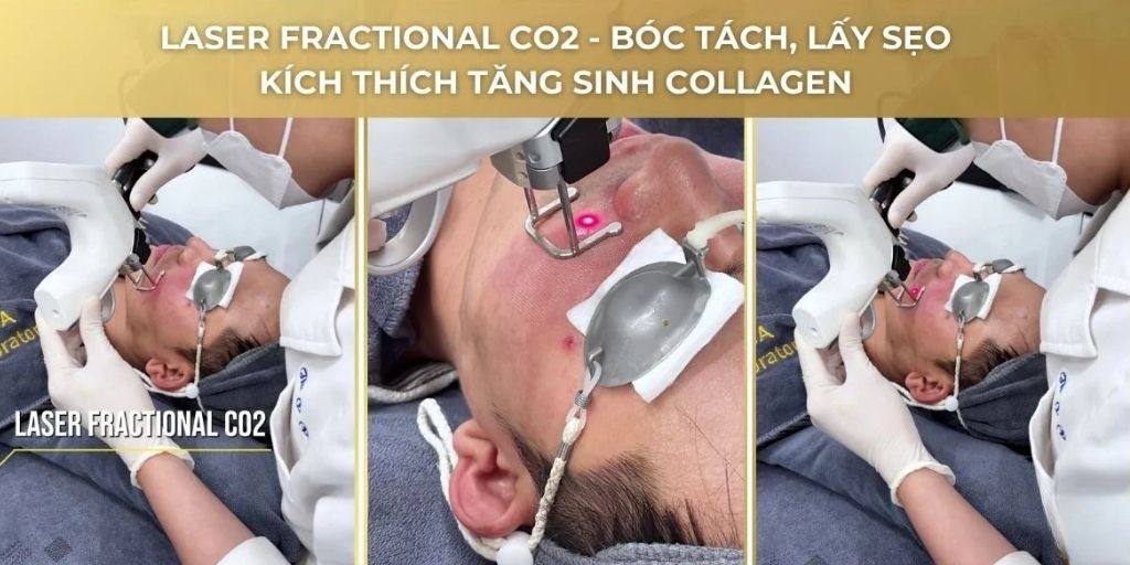 Điều trị sẹo rỗ bằng laser fractional co2