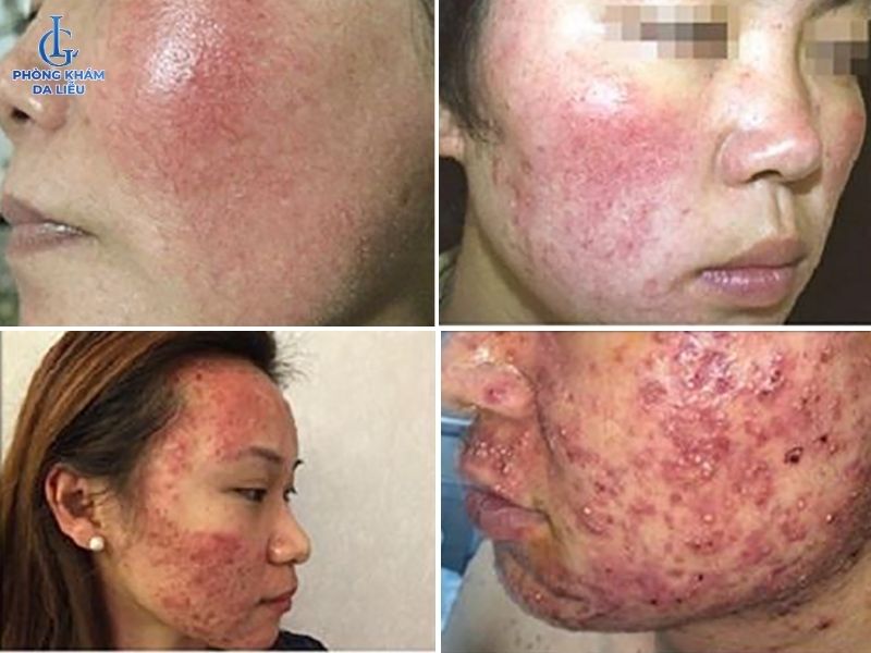 Biến chứng khi trị sẹo rỗ sai cách