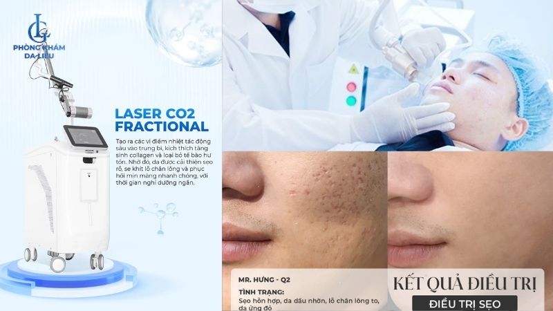 trị sẹo rỗ bằng laser co2 gia bao nhieu