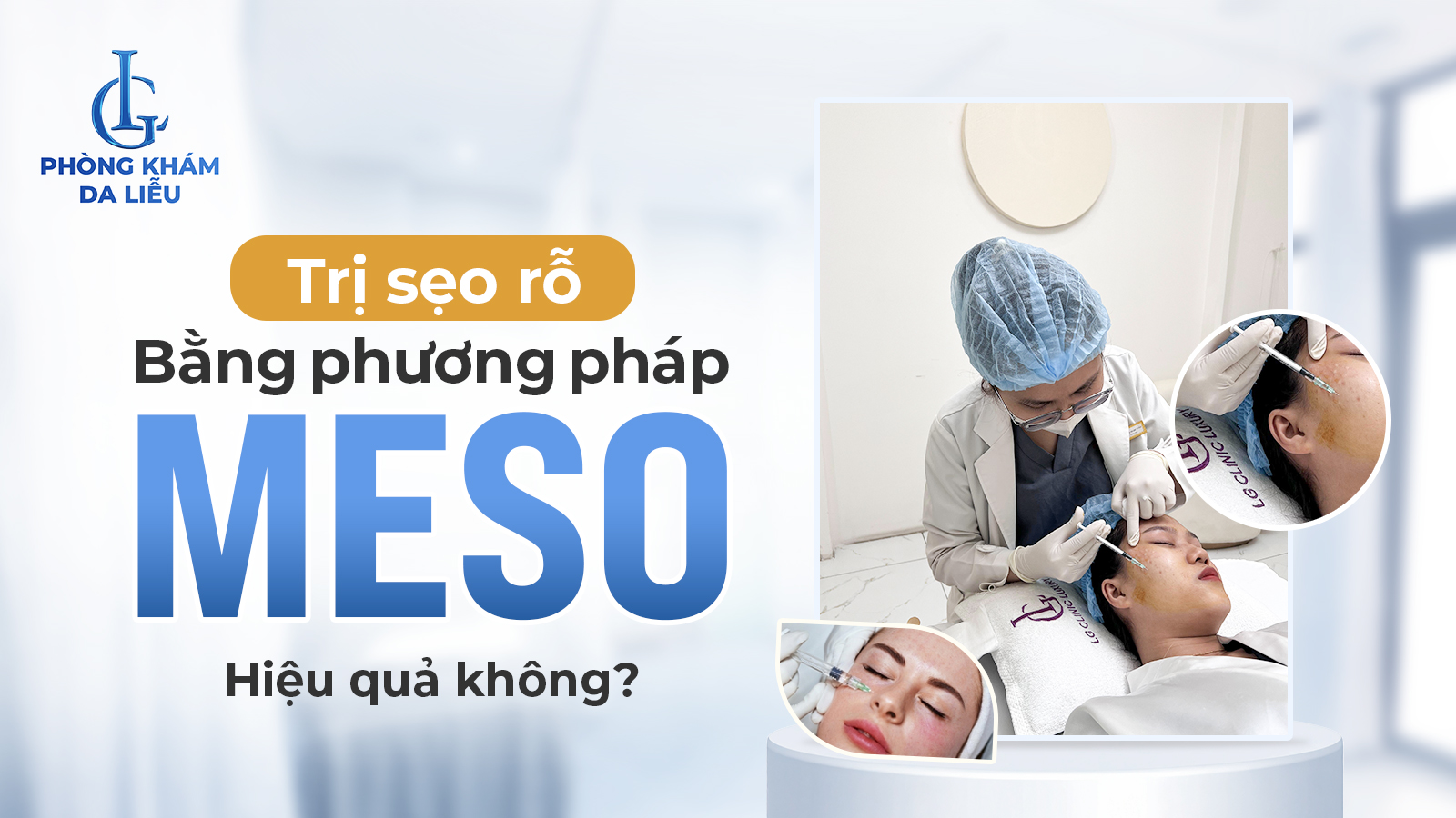 Tiêm meso trị sẹo rỗ