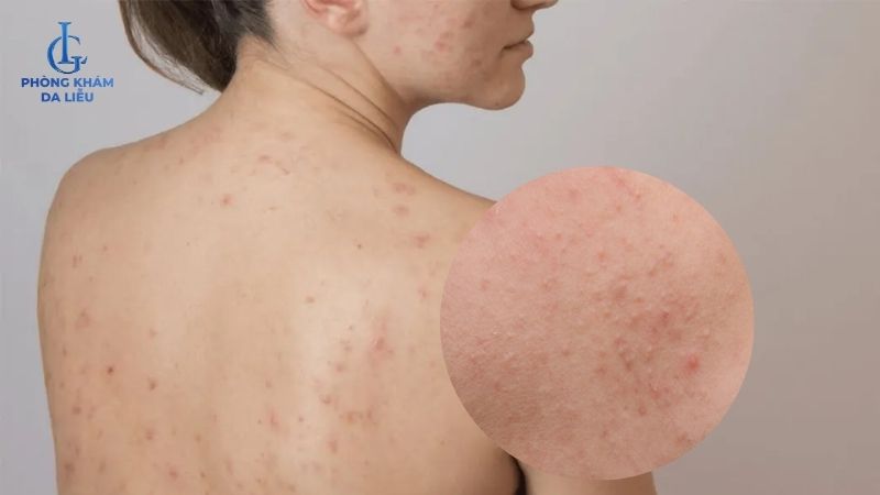 nguyên nhân gây mụn lưng