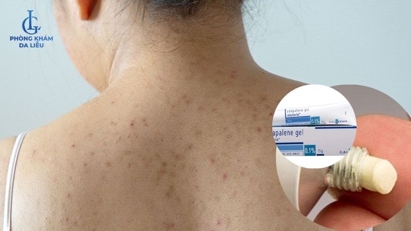 thuốc trị mụn lưng