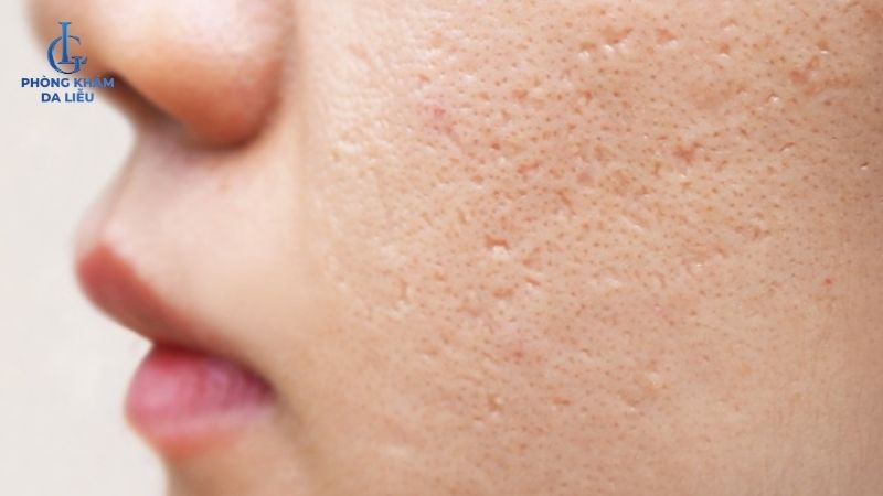  sẹo rỗ trên mặt 