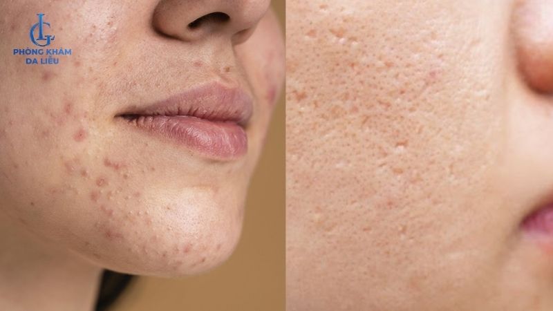 mụn trứng cá gây sẹo rỗ