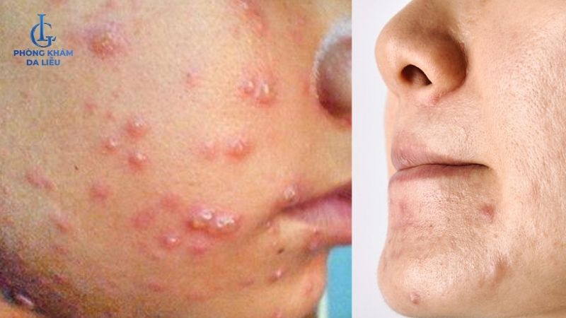 bệnh thuỷ đậu gây sẹo rỗ