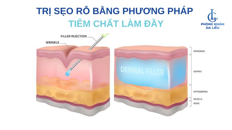 Tiêm chất là đầy trị sẹo rỗ