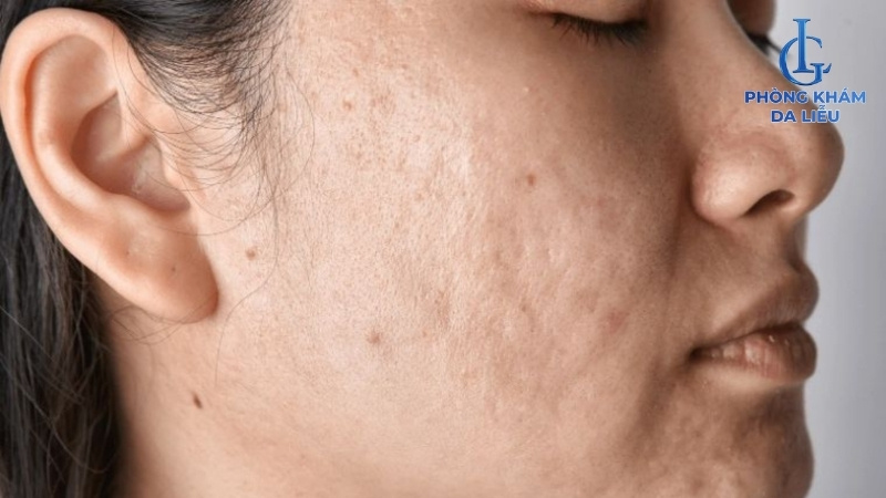 Tretinoin điều trị sẹo rỗ hiệu quả