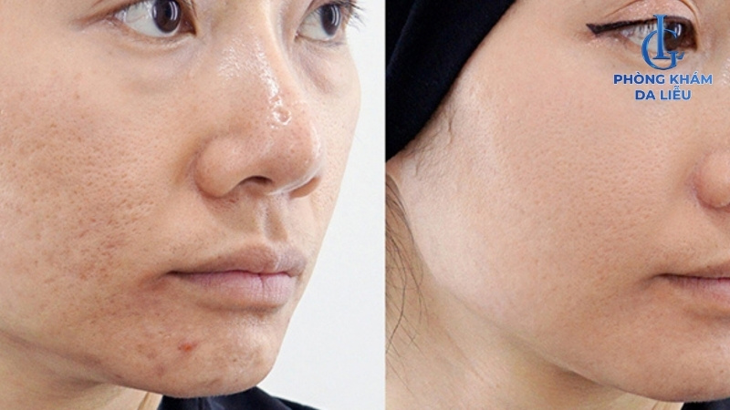 Tretinoin điều trị sẹo rỗ