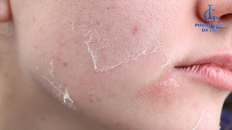 Tretinoin trị sẹo rỗ